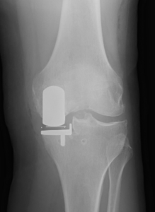 Partial Knee Replacement