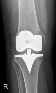 Total Knee Replacement